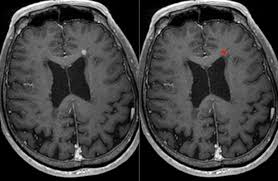 As little as 1% gadolinium can improve the workability of iron and chromium alloys, and their resistance to high temperatures and oxidation. Necessity Of Gadolinium Contrast Comes Under Scrutiny