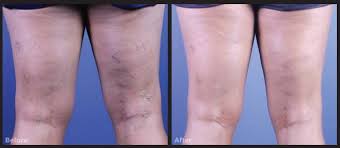 Detailed information related to sotradecol injectable's uses, composition, dosage, side effects and reviews is listed below. Case Study Sclerotherapy Treatment For Leg Veins