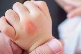 Image result for mosquito bite