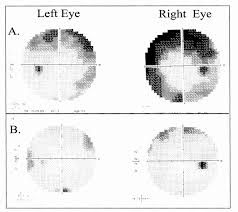Image result for Visual Field Deficit