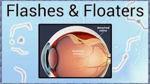 Floaters look like small specks, dots, circles, lines or cobwebs in the field of vision. Flashes Floaters A Sign Of Retinal Detachment Youtube