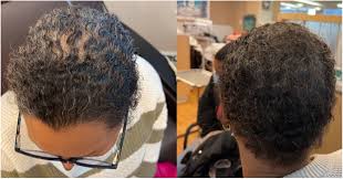Utilization of scalp cooling to prevent chemotherapy-induced alopecia in  woman of skin of color with type 3 hair - JAAD Case Reports