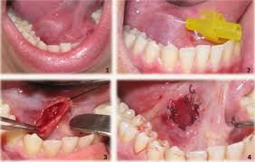 Mucous cyst on lip, roof of mouth, pictures, retention cyst, treat, get rid, home remedies & causes. Treatment Approaches For Odontogenic Cysts Of The Maxillary Sinus Intechopen