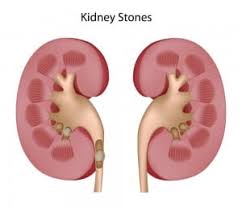 Don T Let Kidney Stones Affect Your Child Children S Hospital Los Angeles