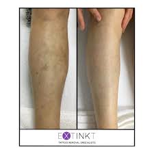 Image result for Pigment stains on the shin