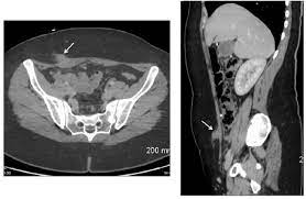 The vast majority of these cases are subsequent to cesarean delivery, presumably via seeding of the abdominal incision with. Figure 3 From Abdominal Wall Endometriosis Mri Features About 31 Lesions With Histological Confirmation Semantic Scholar