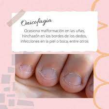 Tics y comportamientos estereotipados semiautomáticos (estirarse del pelo, morderse las uñas, etc.). Truko Nails On Twitter Los Retoques Deberan Ser Cada 15 Dias Para Mantener El Buen Estado De Las Unas Trukonails Oaxaca Oaxacadejuarez Ciudaddeoaxaca Nails Unasdecoradas Unas Onicofagia Unasmordidas Https T Co 4hfy0rgath