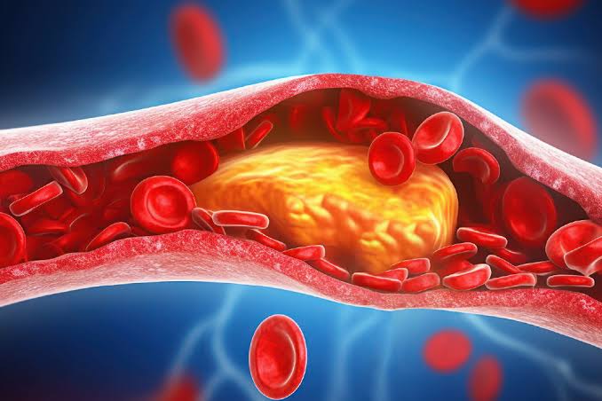 What Causes High Cholesterol