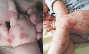 Image result for Hand foot and mouth disease HFMD roof of mouth