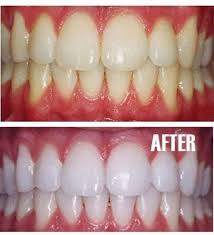 How To Whiten Teeth With Hydrogen Peroxide Beauty Hacks Health And Beauty Diy Beauty