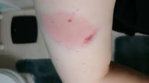 Swelling the most common side effects of emgality are injection site reactions. I Guess I Won T Be Putting Ajovy In My Arm Again 24hr Later Dark Purple Is Injection Site Migraine