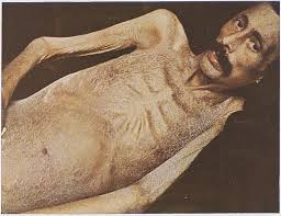 Image result for Cachexia in Cancer