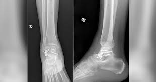 1) severe pain and swelling of the ankle; 26 Year Old Man With Ankle Pain Swelling After Victory Leap Over Tennis Net