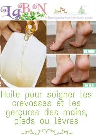 Huile Pour Soigner Les Crevasses Et Les Gercures Des Mains Pieds Ou Levres Whiteheads Pimples Face