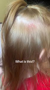 Image result for white scabs on the head in children