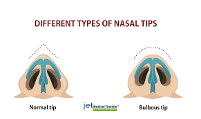 A bulbous nose tip is one that makes your nose to appear as though there is a ball at the end. Bulbous Nose Job Rhinoplasty Jet Medical Tourism In Mexico