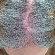 Ringworm and other fungal infections can weaken a person's hair follicles, which can lead to hair loss. What Are The Common Reasons For Scalp Redness And Pain Photos