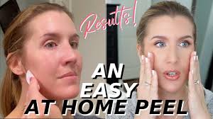 The chances are that you will not regret using this chemical peel and you will. At Home Glycolic Acid Peel That Works Over 40 Skincare Youtube