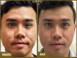 Kết quả hình ảnh cho ảnh trị sẹo
