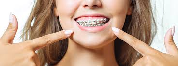 Die preise für eine festsitzende zahnspange differieren stark, da sie von vielen individuellen faktoren abhängig sind. Fixe Zahnspange Wie Brackets Zahne Zurechtrucken Herold At