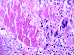 Image result for Myocarditis