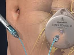 Image result for Intrathecal Pump