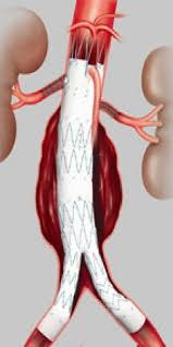 Dr bahman rasuli ◉ and associate professor donna d'souza ◉ et al. Aneurisma De Aorta Abdominal