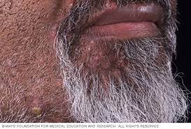 Over wight facial hair acne on arms back bumps blackheads heavy feeling, not feeling fresh in office tummy incresases hairs on chin, stomach. Ingrown Hair Symptoms And Causes Mayo Clinic