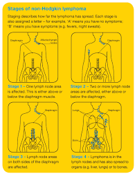 Zj2nw2gyekv Wveqxounfmid M36chljulcbnu4h Non Hodgkins Lymphoma Lymphoma Cancer Hodgkins Lymphoma