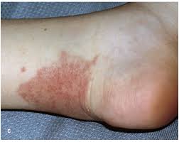 Dermatofibroma is a blemish that typically develops on the lower legs in women, although they can happen anywhere on the body. Skin Signs Of Vascular Disorders Cardiology