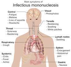 Instead, they may primarily experience prolonged fever, fatigue, malaise and body pains. File Main Symptoms Of Infectious Mononucleosis Png Wikipedia