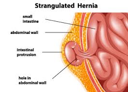 How to prevent hernia from getting worse. Tips To Prevent Hernia While Working Out Icici Lombard