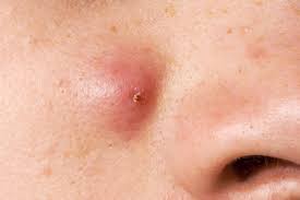 On the area where a cyst is formed, one may also identify a green or yellowish pus with. Cysts On Skin Pictures Of What They Look Like