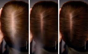 Hair loss is one of the most common problems worldwide; How To Hide Gray Hair Without Dye And Things We Shouldn T Do To It