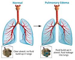 Dr Rafidah Abdullah On Twitter Paru Paru Berair Pulmonary Edema Boleh Disebabkan Oleh Kegagalan Buah Pinggang Air Bertakung Tak Boleh Keluar Ps Bukan Sbb Mandi Malam Https T Co 3o6jxgf3zi
