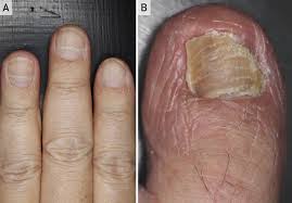 Image result for Beau lines feet