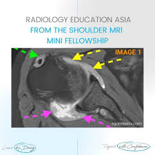Image result for Shoulder MRI