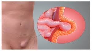 Que Son Las Hernias Inguinales Hogartv Por Juan Gonzalo Angel Youtube