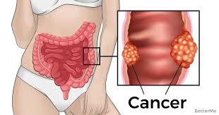 If you notice blood in your stool, this could be a telltale sign of colon cancer. 7 Early Warning Signs Of Rectal Cancer No One Want To Talk About