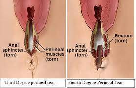 Jangkitan saluran kencing adalah jangkitan oleh mikroorganisma (kuman) pada bahagian tertentu saluran kencing samada pada ginjal, ureter, pundi kencing jangkitan pada saluran kencing bawah merupakan jangkitan yang kerap berlaku. Bagaimana Mempercepatkan Proses Pemulihan Pada Luka Di Faraj Atau Luka Episiotomy Dr Zubaidi Hj Ahmad Menulis