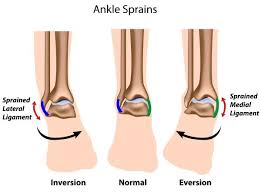 The anterior talofibular ligament, the posterior talofibular ligament, and the calcaneofibular ligament. Anterior Talofibular Ligament Sprain Ankle Sprain