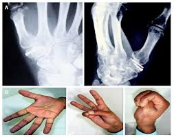 Image result for Trapezoid Bone