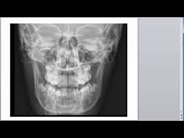 Image result for Skull XRay