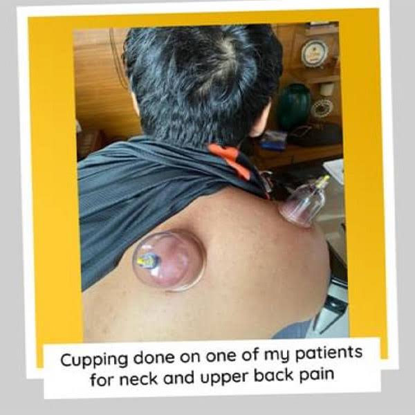 Cupping product image