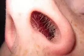 Using small cuticle or embroidery scissors usually is the safest way to cut any hairs that are protruding from the nostril. How To Stop Hair Growing On The Top Of My Nose Quora