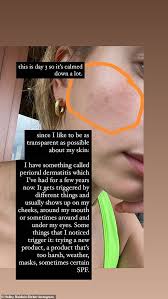 You need to install flash or a modern browser to see the video. Hailey Bieber Reveals Her Struggles With A Skin Condition As She Posts A Bare Faced Selfie Aktuelle Boulevard Nachrichten Und Fotogalerien Zu Stars Sternchen