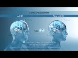 Adhd is associated with cognitive and functional deficits that relate to diffuse abnormalities in the brain. King S College London Neurobiology Animation Youtube
