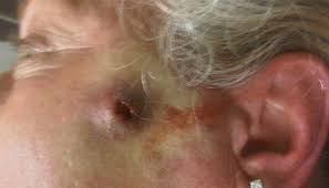 Due to its looks and habits, the wolf spider has earned a reputation of being a vicious predator and is even often mistaken for a tarantula. Wolf Spider Bite Pictures Symptoms What It Looks Like On Dog Cat Human Dangers Treatment Pestbugs