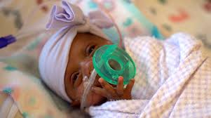 Worlds Tiniest Baby Survives After 6 Months In Hospital Weighing Only 8 6 Ounces 245 Grams At Birthhttp Time Com 5 Small Baby Premature Baby Healthy Babies