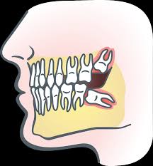 How long do you wear gauze after wisdom teeth removal? Wisdom Teeth In Teenagers Frisco Kid S Dentistry